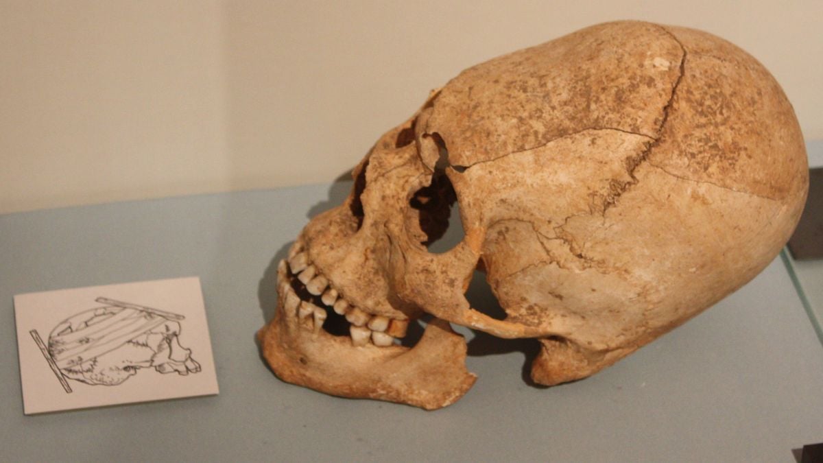 Mysterious deformed skulls have been found around the world, researchers want to know why