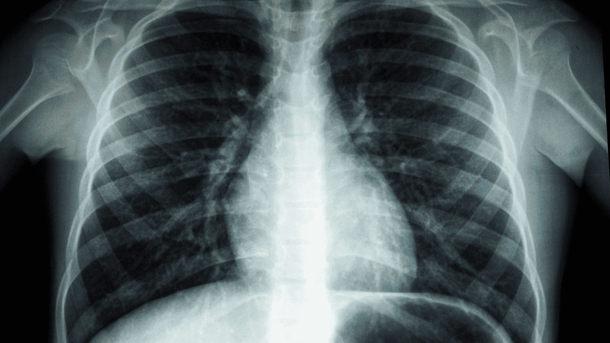 We thought we had gotten rid of the deadliest infection in the world: yet it is making a comeback