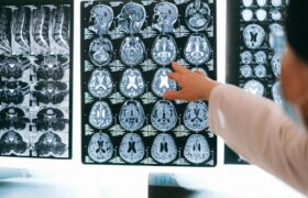 The number of hard-to-diagnose “invisible” cancers has exploded in recent years